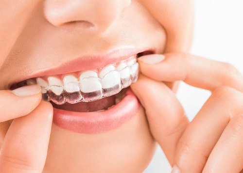 Braces & Clipping (Orthodontics), Sanjeevani Dental Clinic, Dentist, Orthodontist, Dental Clinic, Dental Services